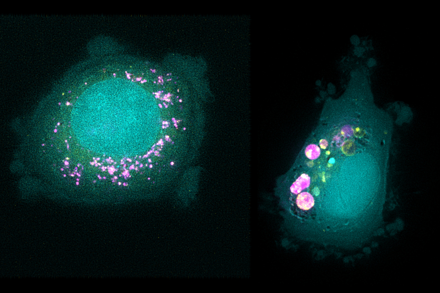 Cómo responden las diferentes células cancerosas a las nanopartículas que liberan fármacos