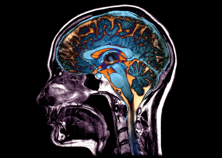 Cinco formas en que el cerebro puede envejecer: 50.000 escáneres revelan posibles patrones de daño