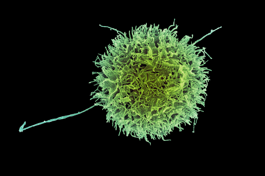Las células “asesinas naturales” diseñadas podrían ayudar a combatir el cáncer